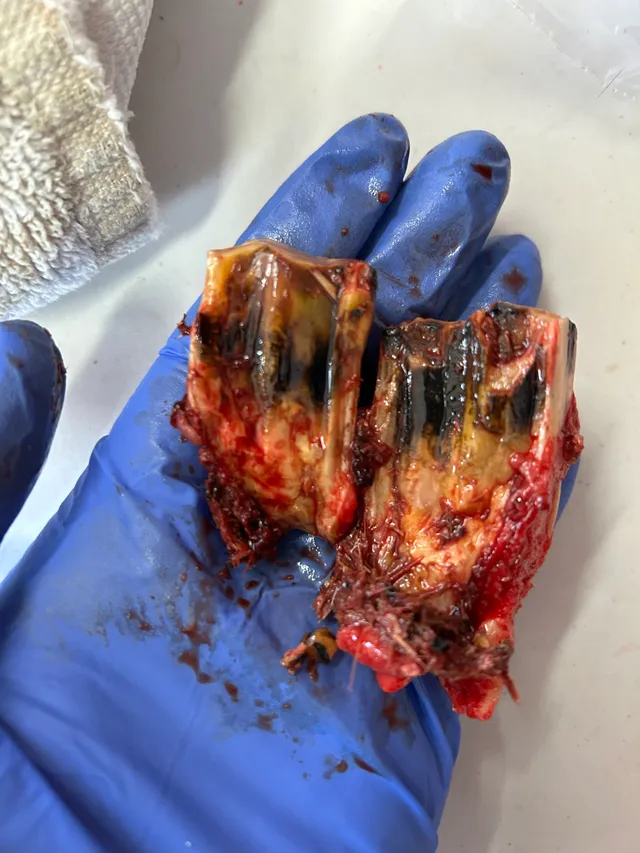 Intraoral Tooth Extractions